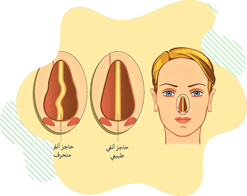 تقويم حاجز أنفي 